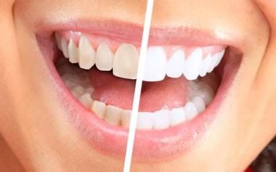 What Are the Differences Between Professional Teeth Whitening and Over-the-Counter Options?
