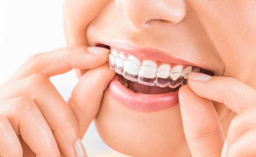 Invisalign - Cosmetic Dentistry straighten teeth in as little as six months