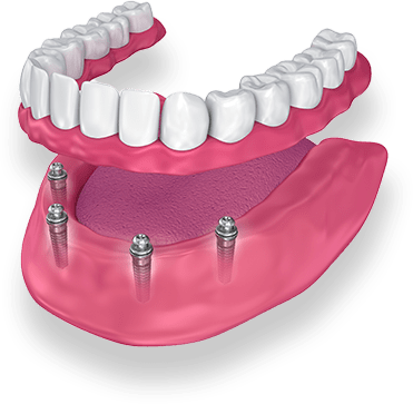 Denture Implant Services, give the look feel and function of natural teeth