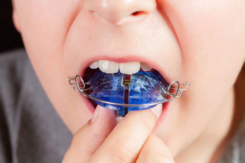 Child with orthodontic appliance close-up