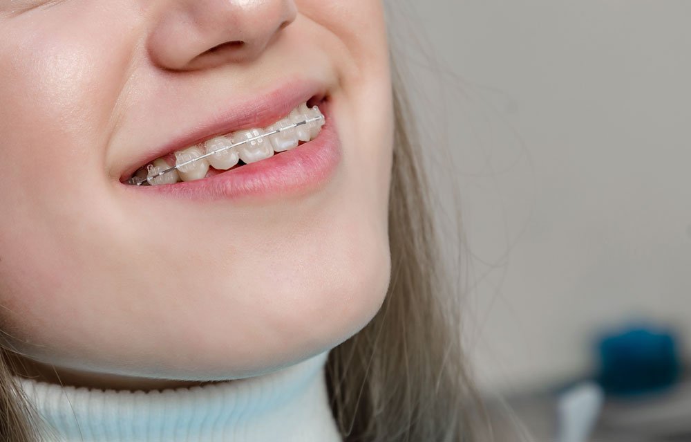 Braces are set on the teeth, girl's smile. Bite Correction