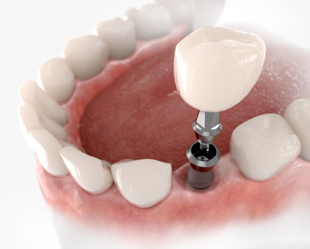 Implant-Stabilized Dentures