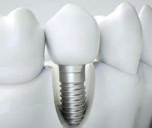 implants dental