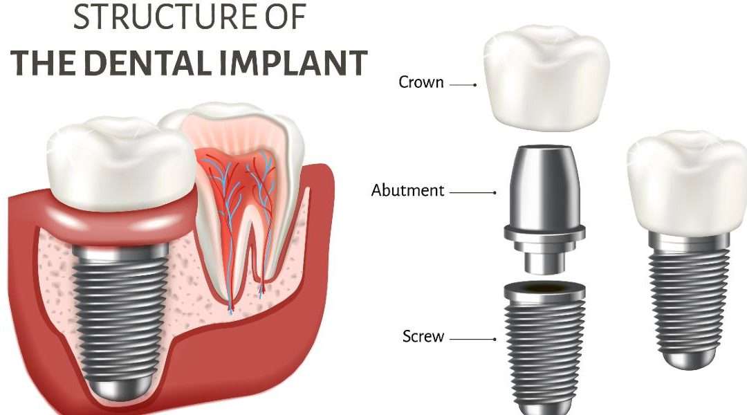 Manhattan Beach Dental Implants